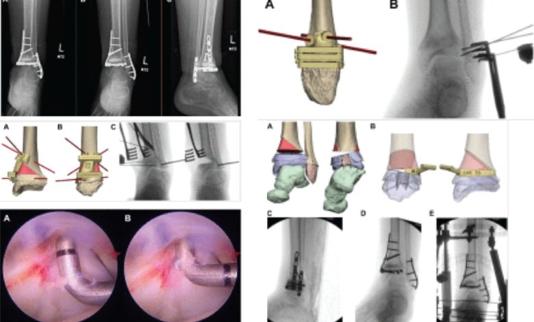 Yale team using 3D surgical planning to advance pediatric orthopedic outcomes
