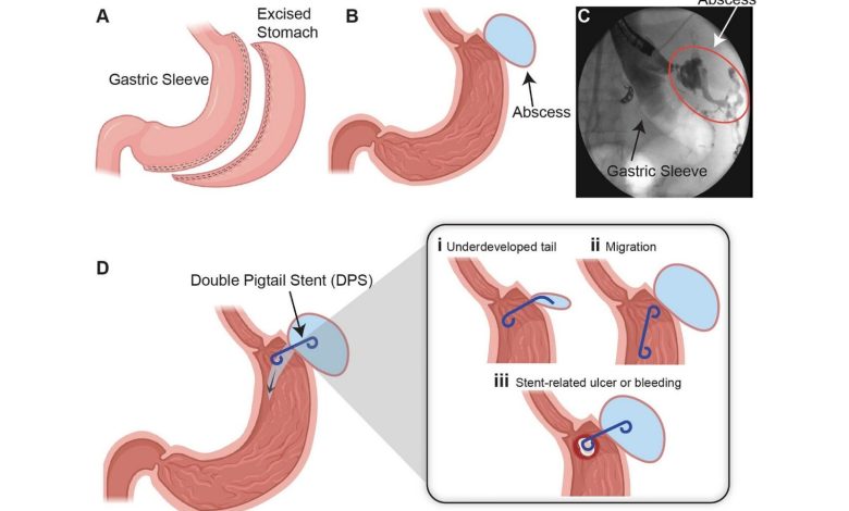 3D printed stents outperform commercial devices in gastric leak study