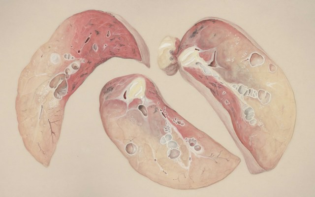 UPMC and UCSF researchers use 3D printed models to plan pulmonary vascular malformation embolization