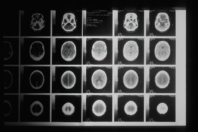 Regina Margherita researchers rate 3D reconstruction above 2D imaging for pediatric kidney surgery